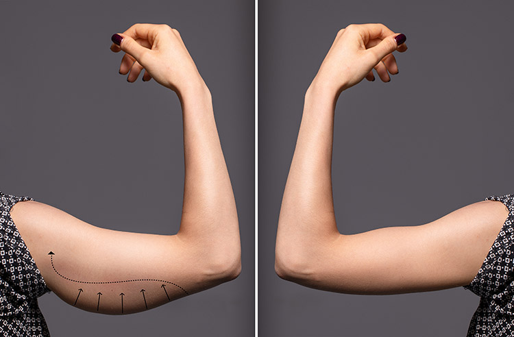Kol Germe Arm Lift