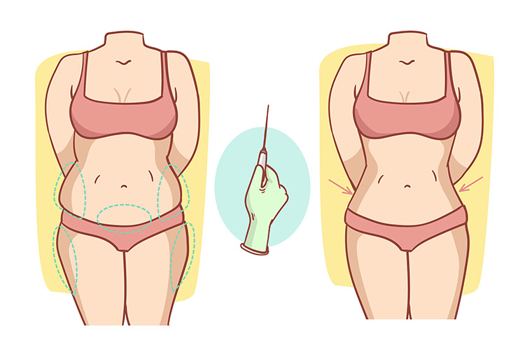 liposuction